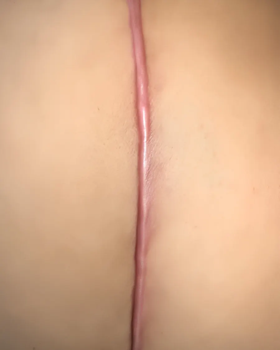 Advanced Scar Management with Hypertrophic Scar Treatment at Cinch Clinics